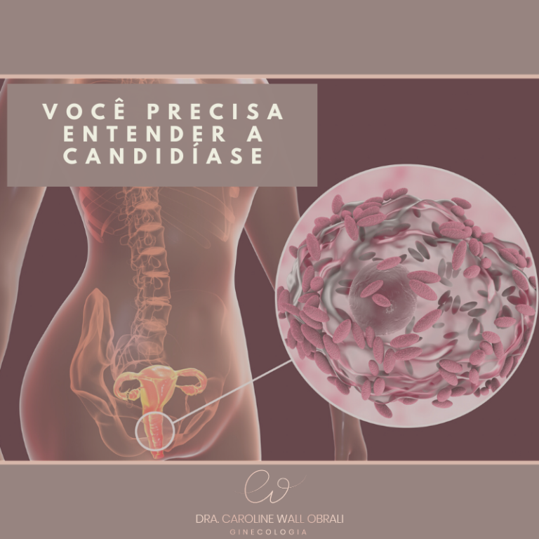 Candidíase | Dra. Caroline Obrali | Ginecologista Curitiba